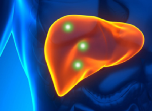 Fluor tumor