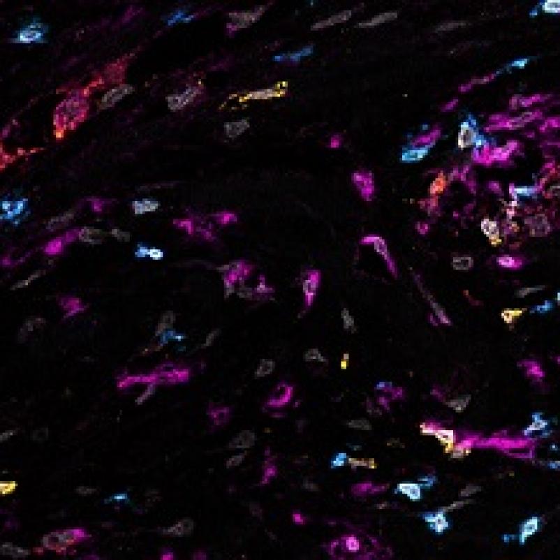 Microscopische weergave van botkanker(cellen)
