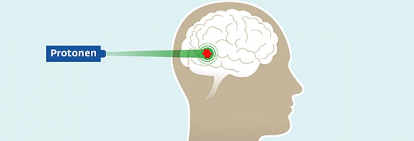 Illustratie protonentherapie
