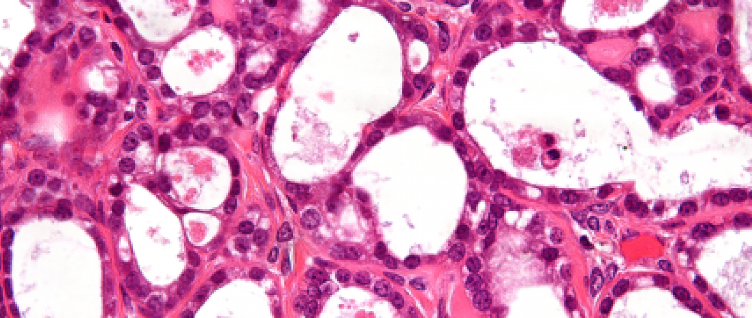 Heldercellig ovariumcarcinoom